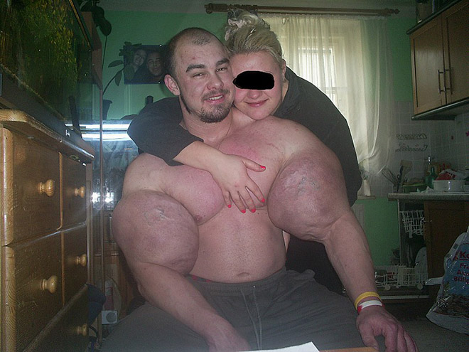 Synthol freak.