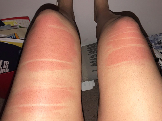 Spending time in the sun while wearing ripped jeans might not be the smartest choice.