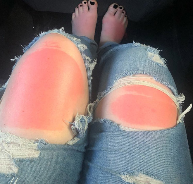 Spending time in the sun while wearing ripped jeans might not be the smartest choice.